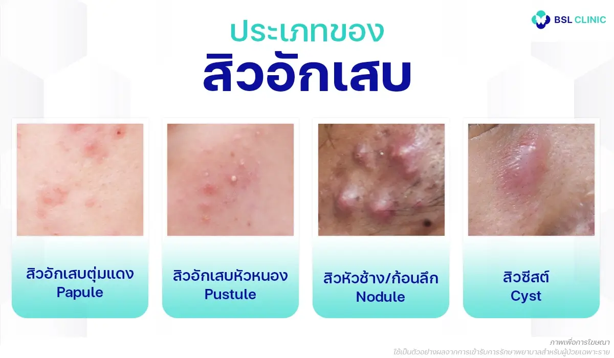 รักษาสิวอักเสบ