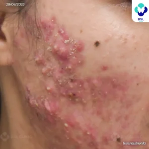 สิวหัวช้างก้อนลึก