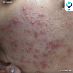 สิวอักเสบหัวหนอง