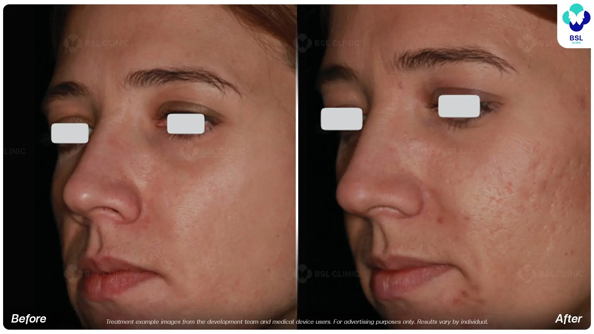 Acne Scars and Other Scars