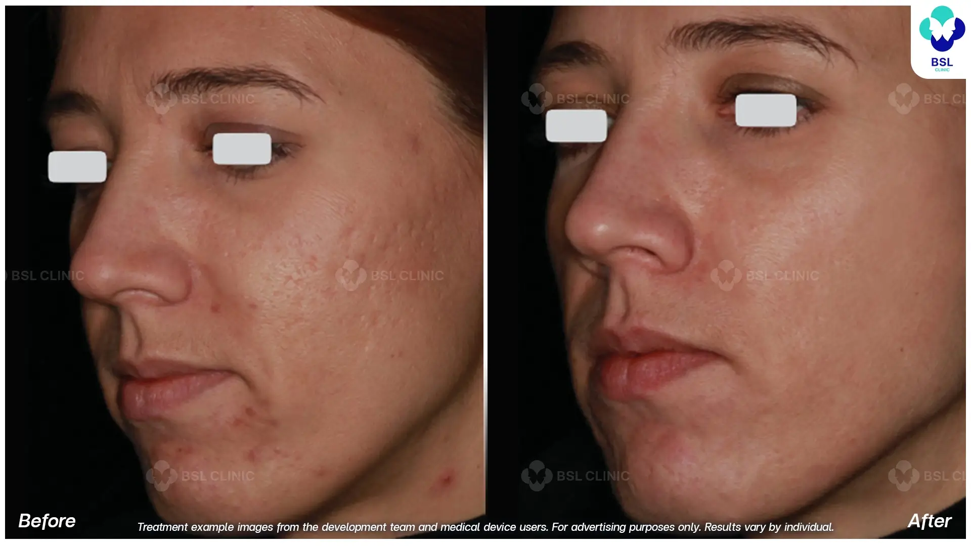 Acne Scars and Other Scars