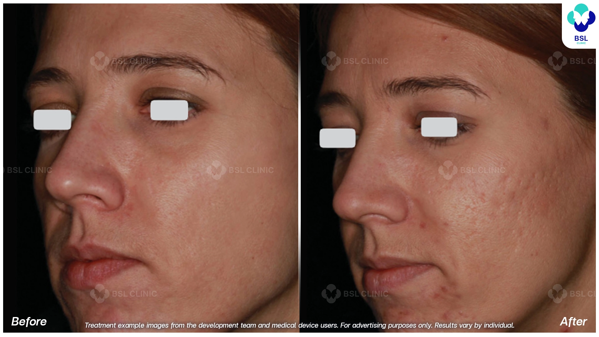 Acne Scars and Other Scars