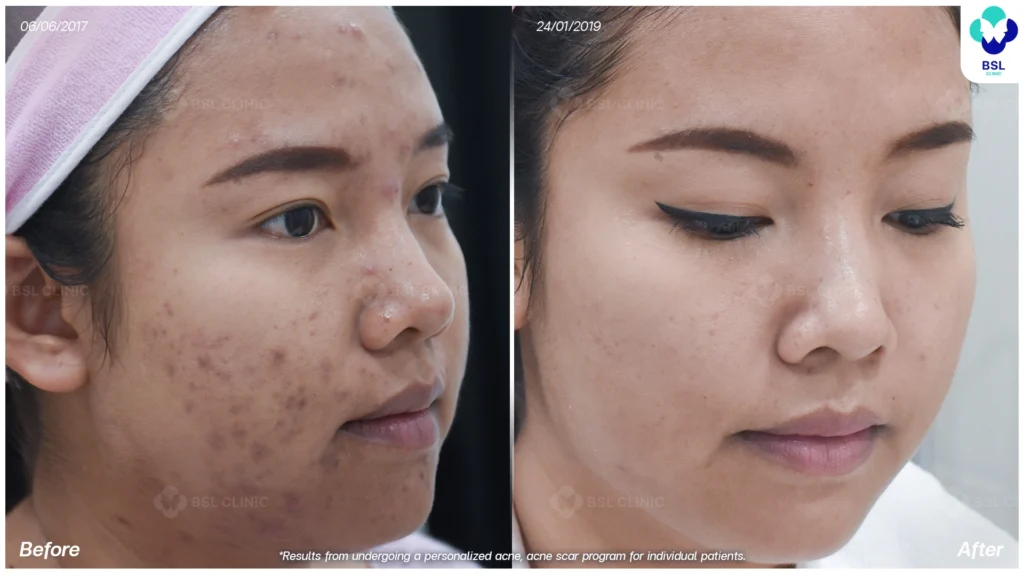 รีวิว ก่อนและหลัง โปรแกรมรักษาสิว รอยสิว หลุมสิว