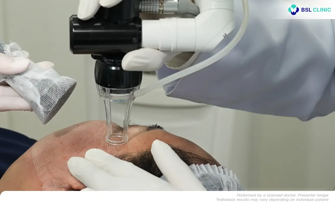 Fractional CO2 laser program at BSL Clinic tailored by adjusting energy level, density, and depth for personalized skin resurfacing and natural regeneration