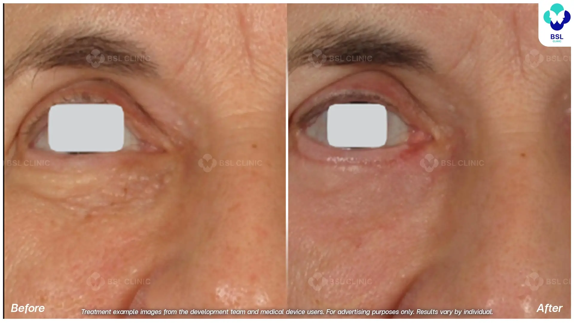 Fractional CO2 Laser Before and After