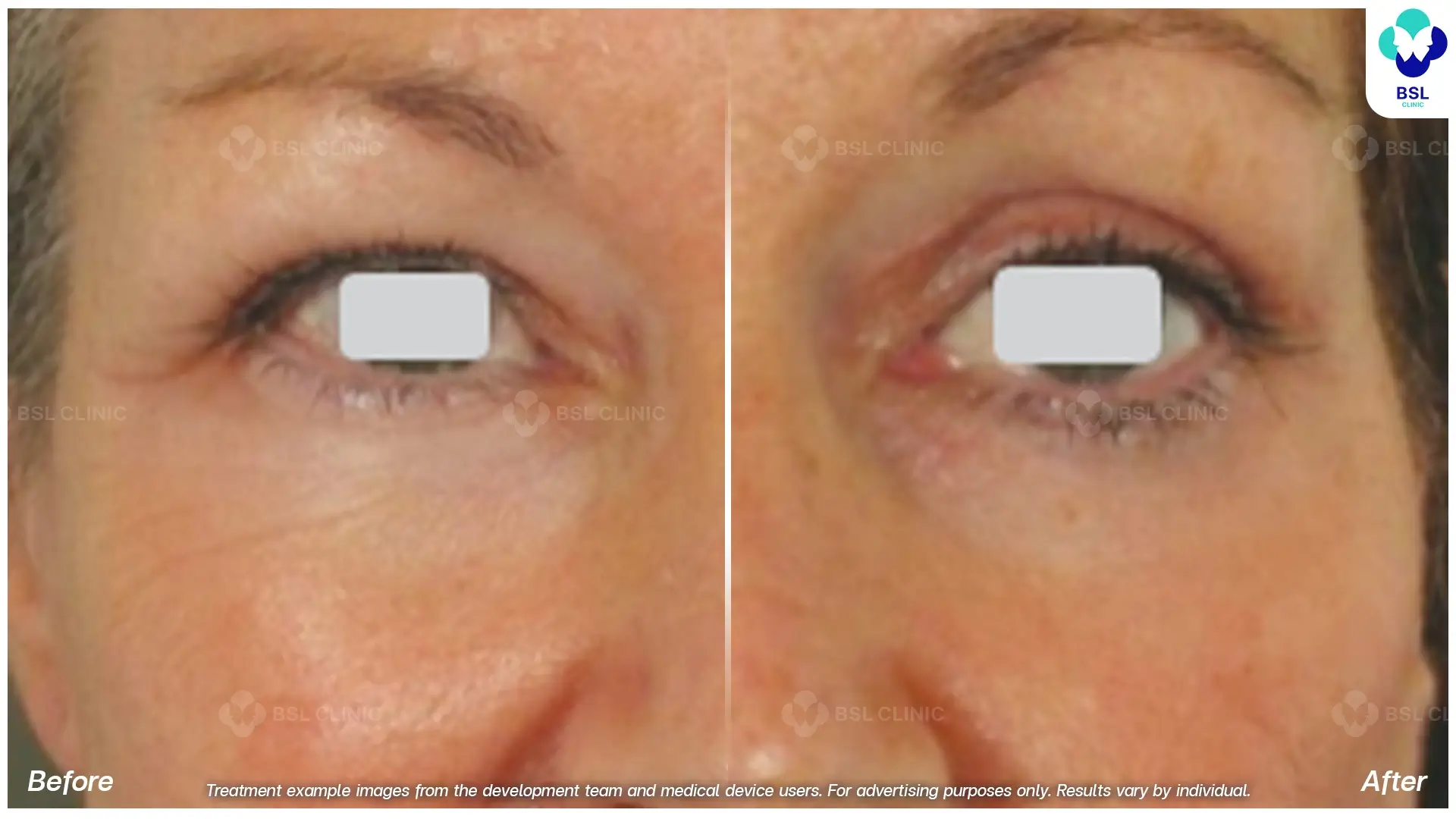 Fractional CO2 Laser Before and After