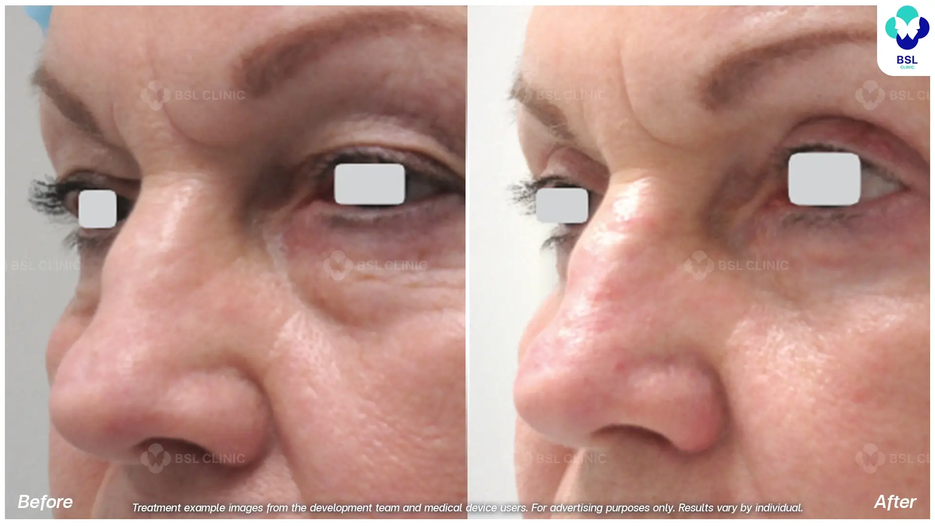 Fractional CO2 Laser Before and After