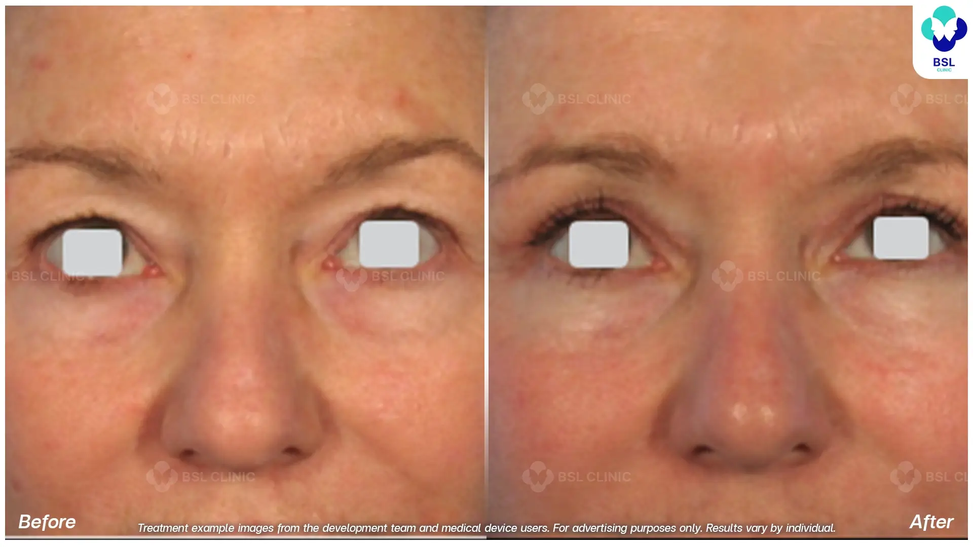 Fractional CO2 Laser Before and After
