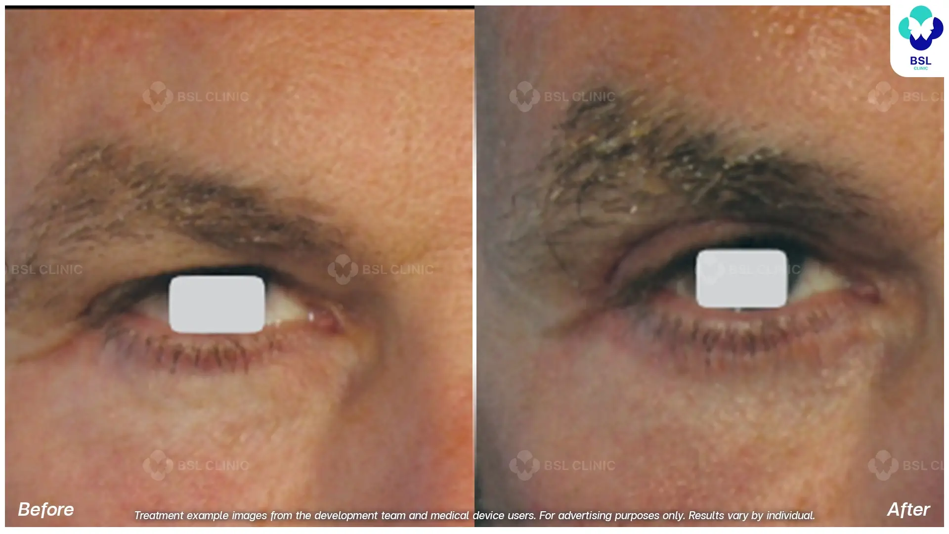 Fractional CO2 Laser Before and After