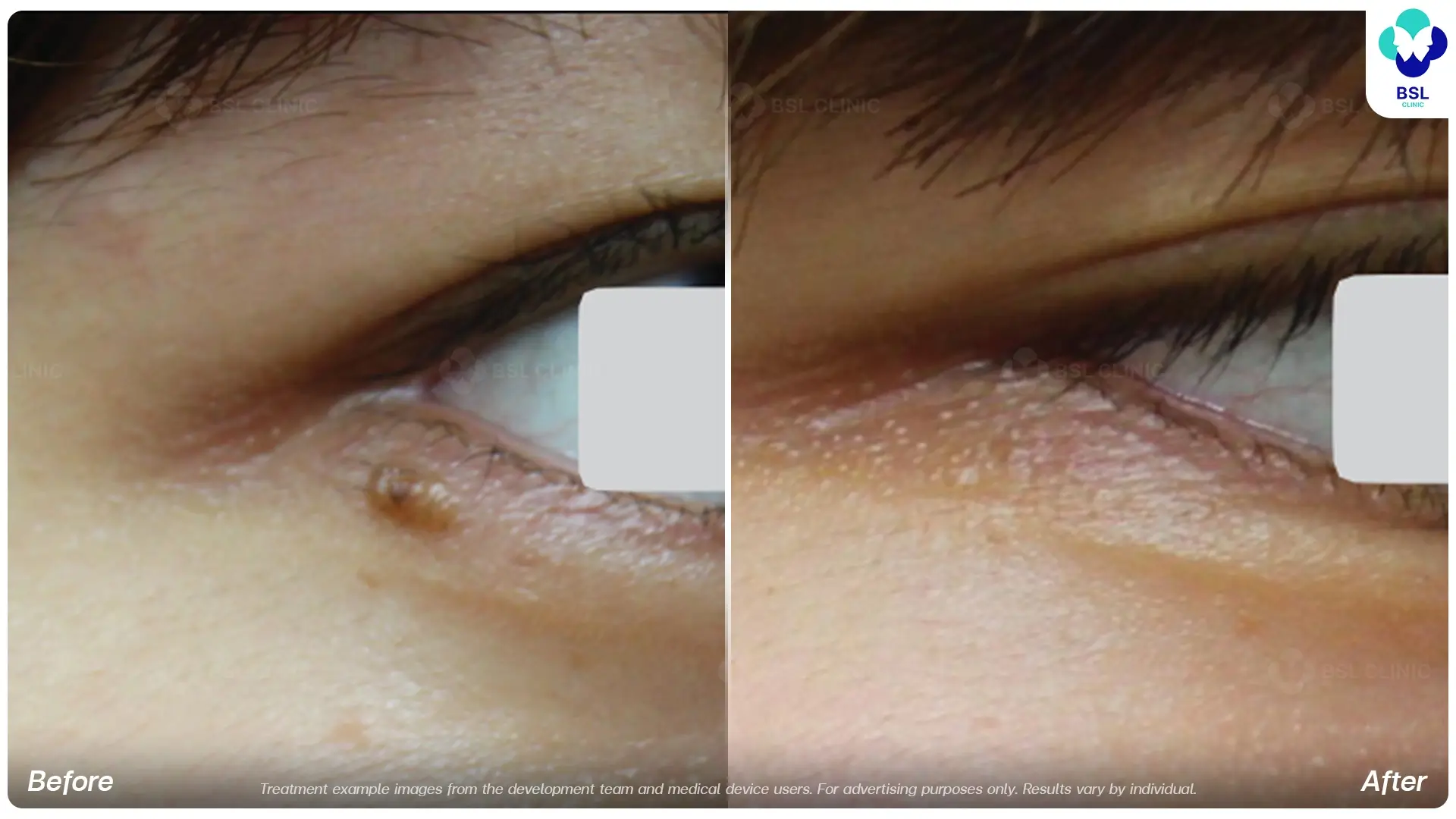Fractional CO2 Laser Before and After