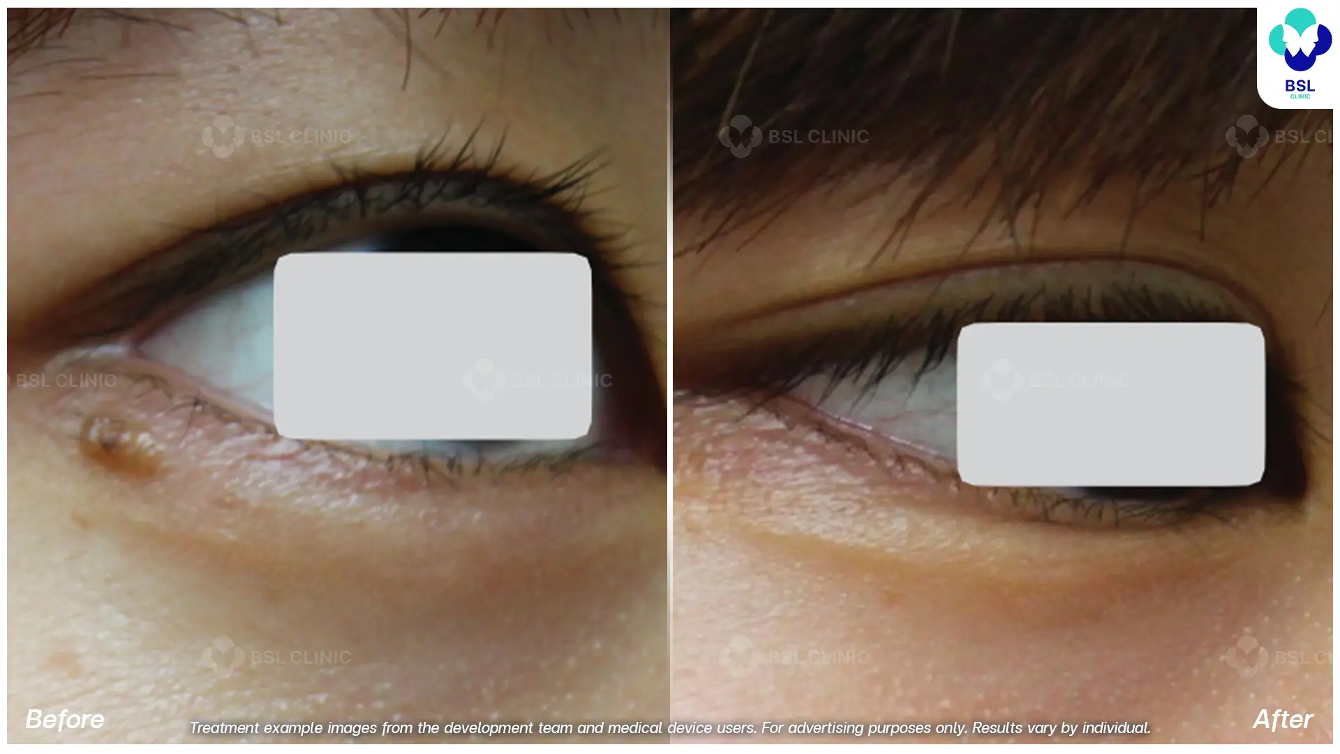 Fractional CO2 Laser Before and After