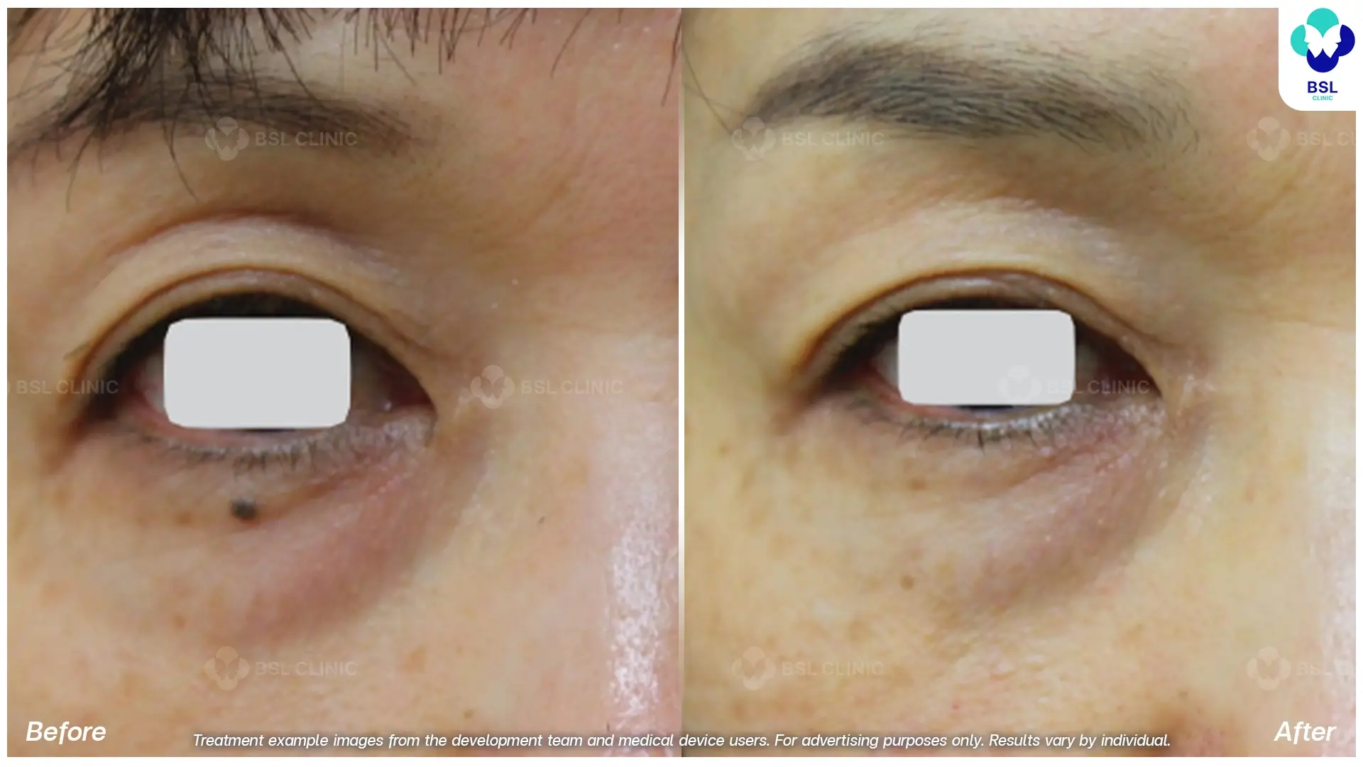 Fractional CO2 Laser Before and After