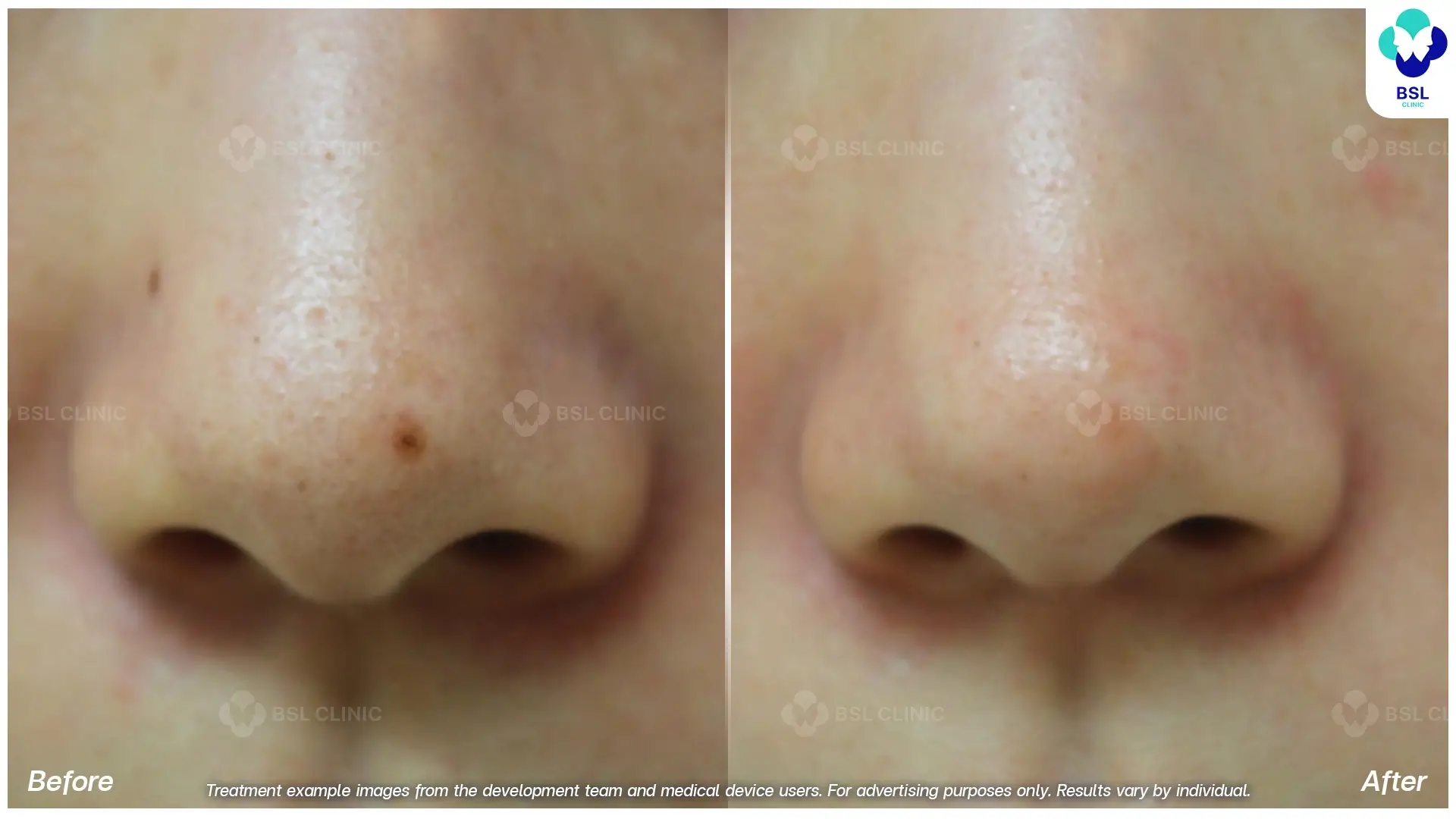 Fractional CO2 Laser Before and After