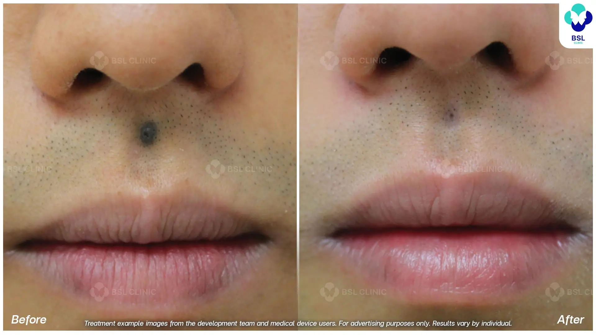 Fractional CO2 Laser Before and After