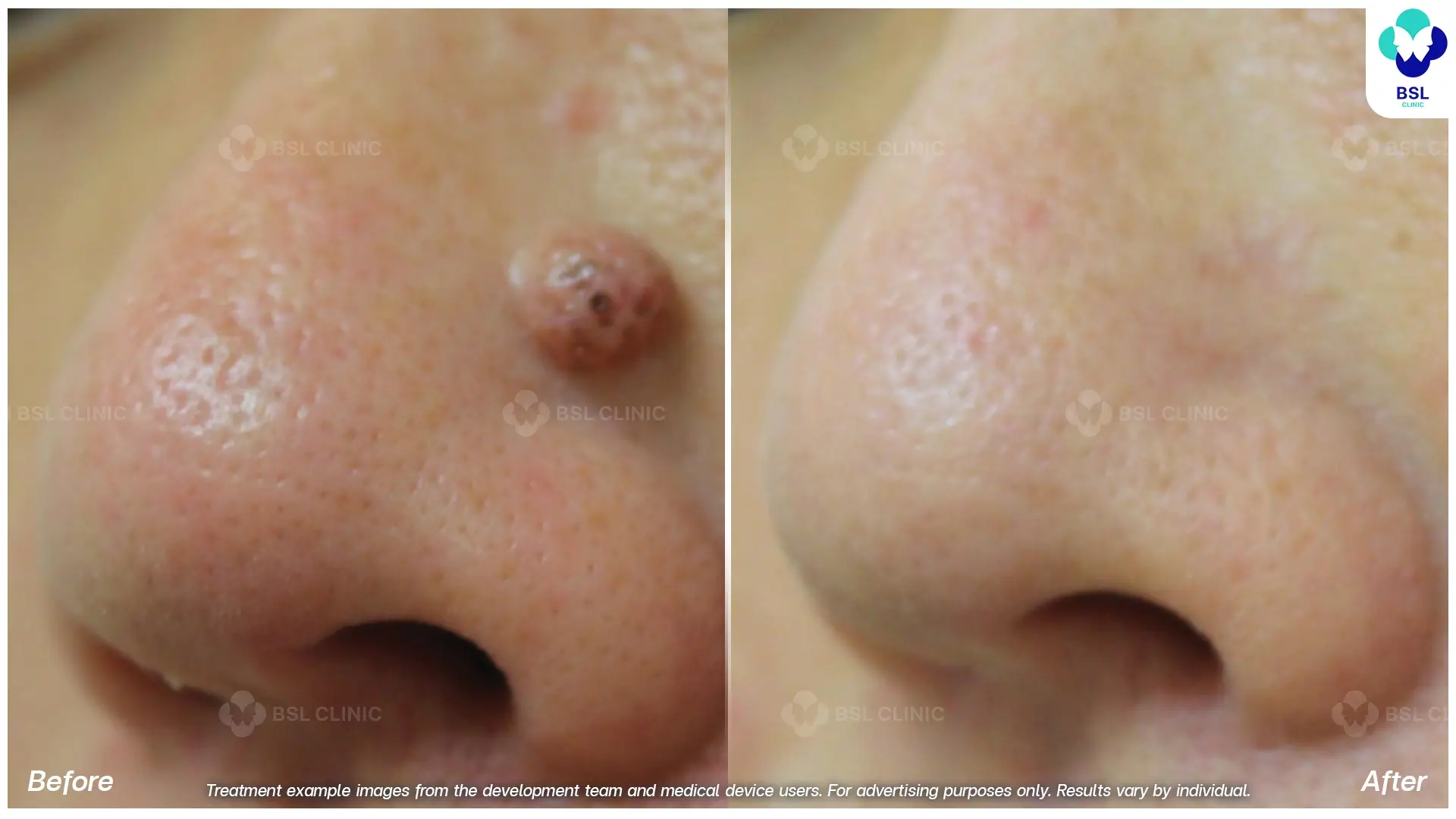Fractional CO2 Laser Before and After