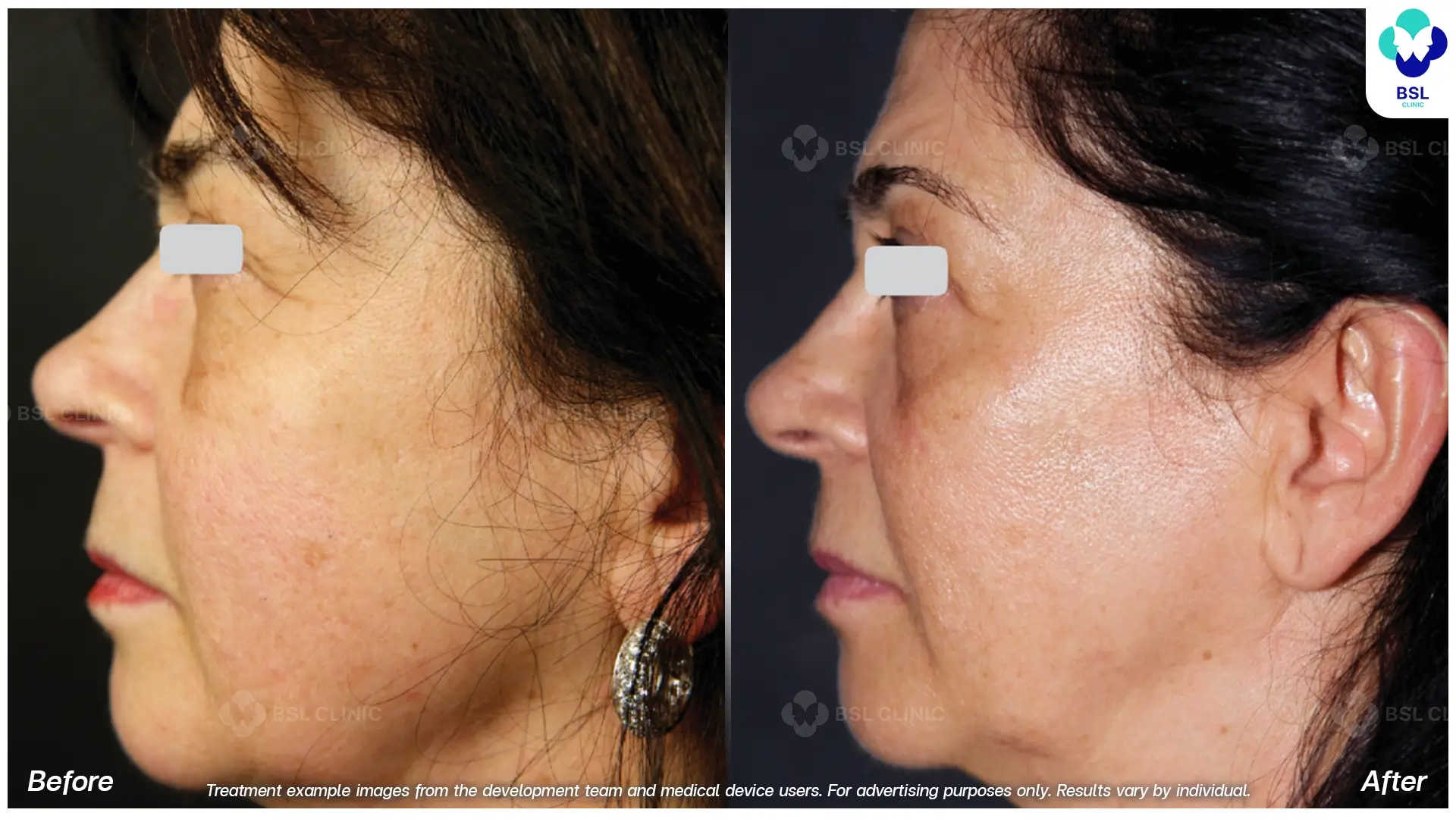 Fractional CO2 Laser Before and After