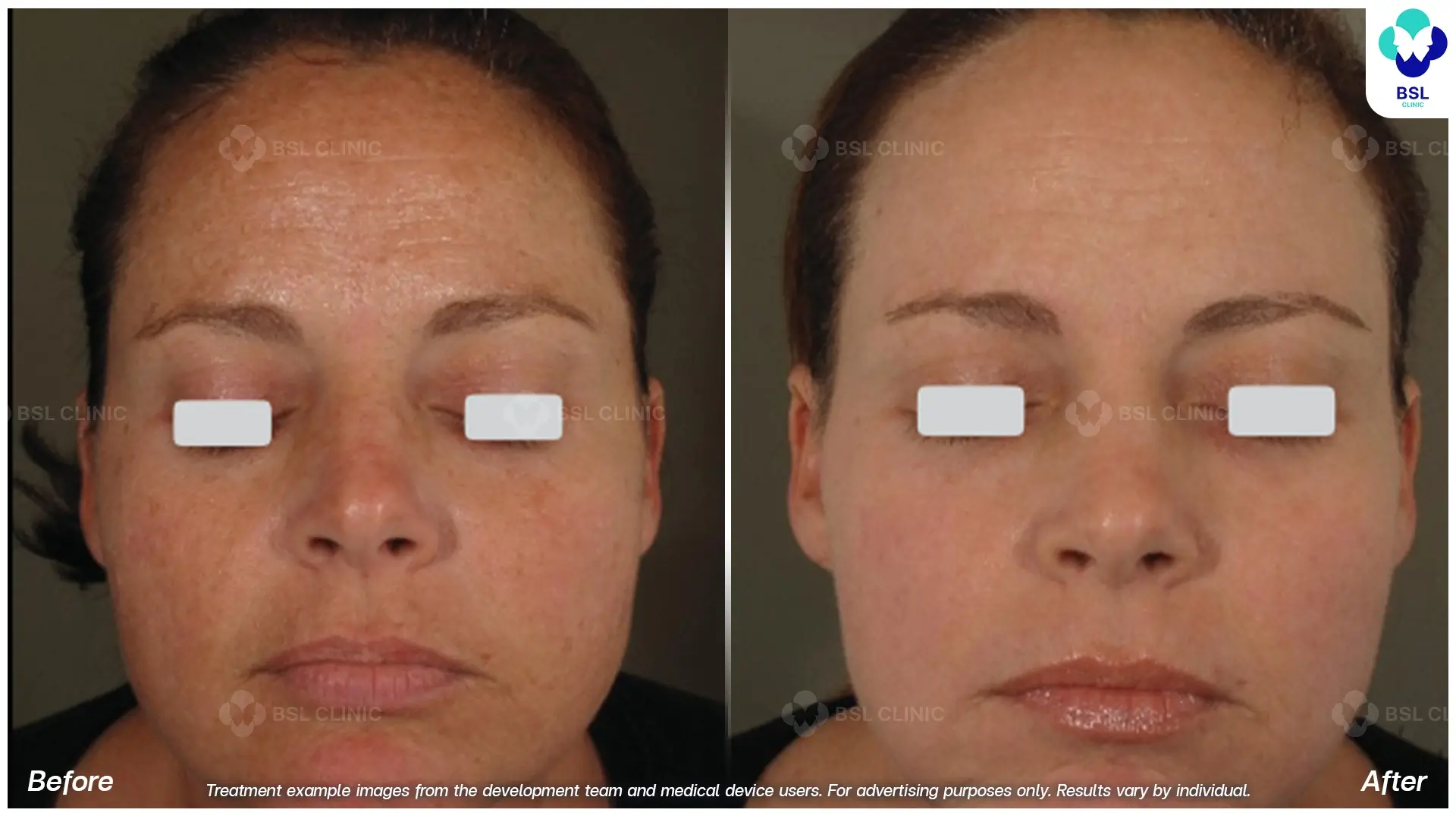 Fractional CO2 Laser Before and After