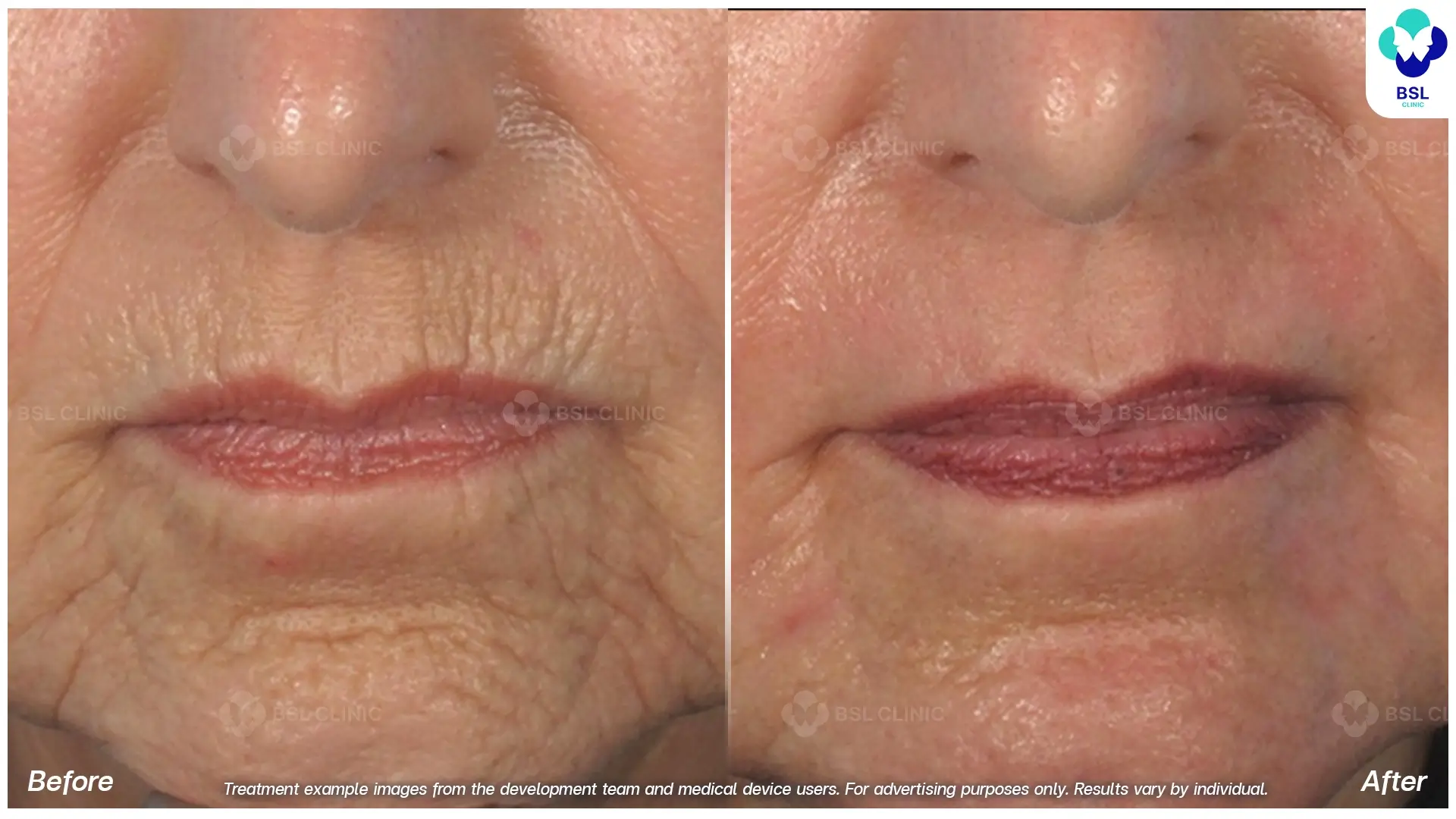 Fractional CO2 Laser Before and After
