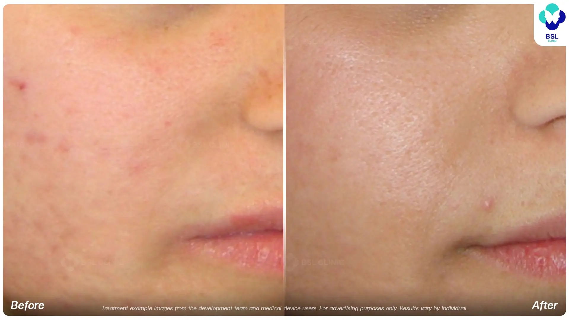 Fractional CO2 Laser Before and After