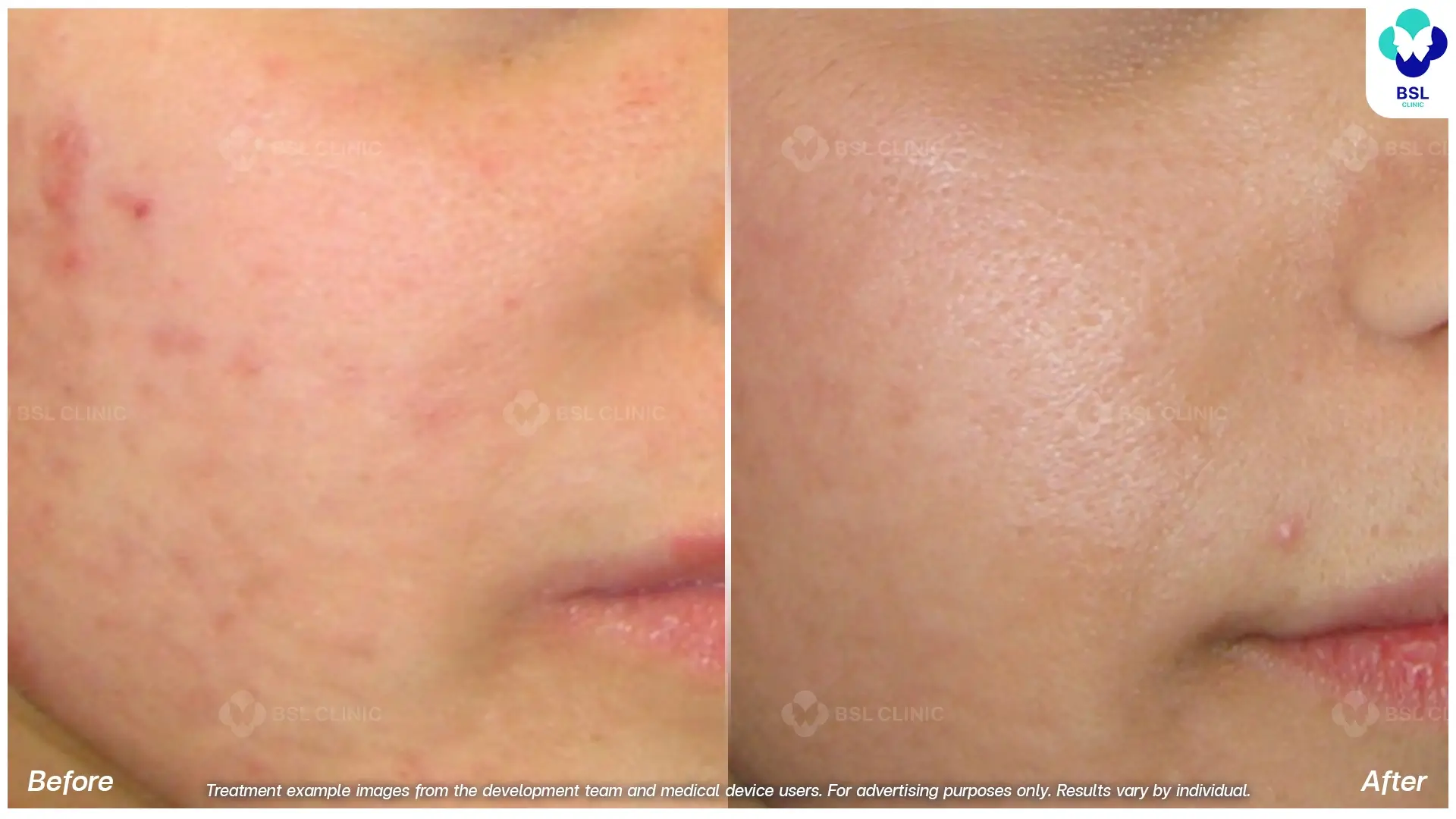 Fractional CO2 Laser Before and After