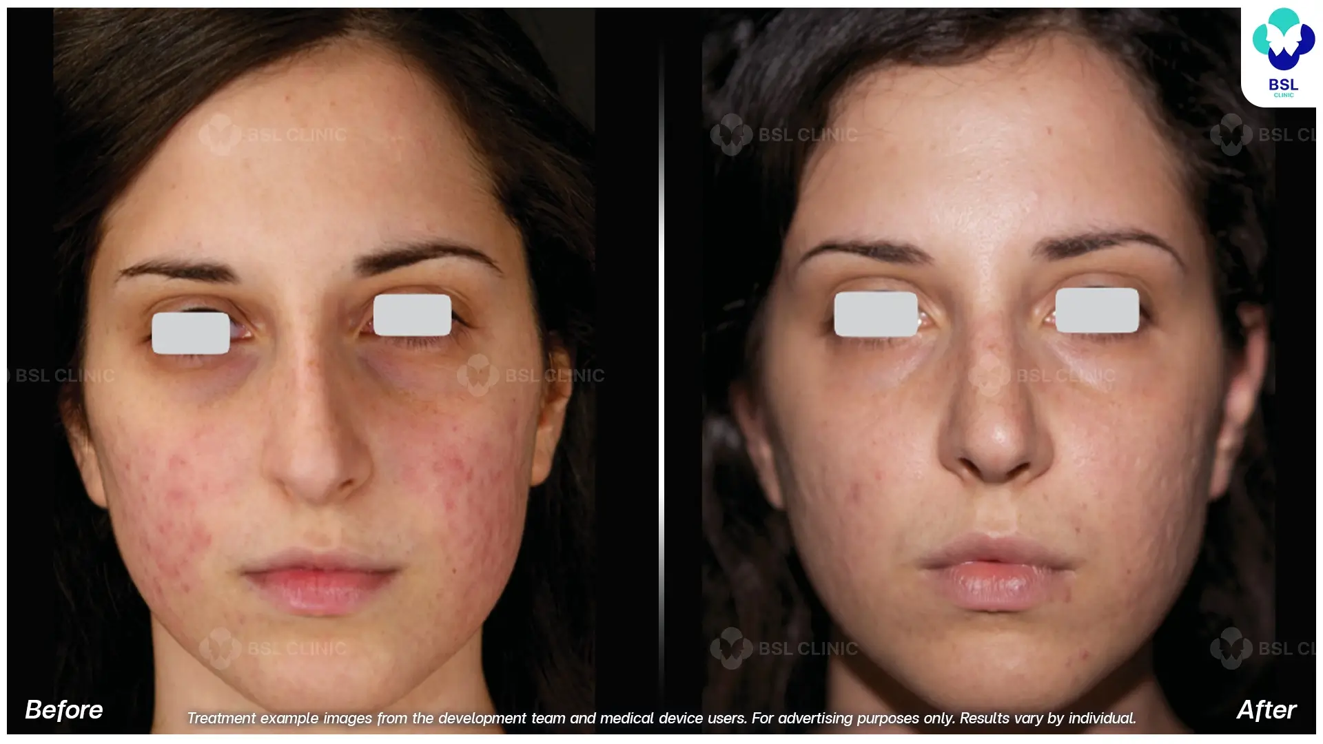 Fractional CO2 Laser Before and After