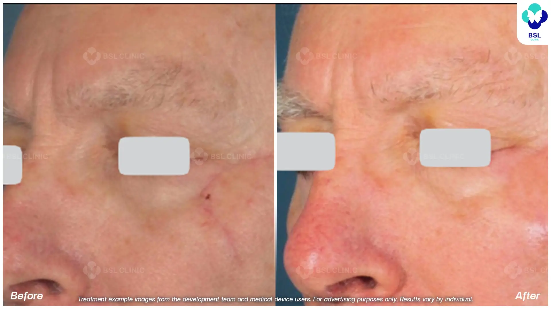 Fractional CO2 Laser Before and After