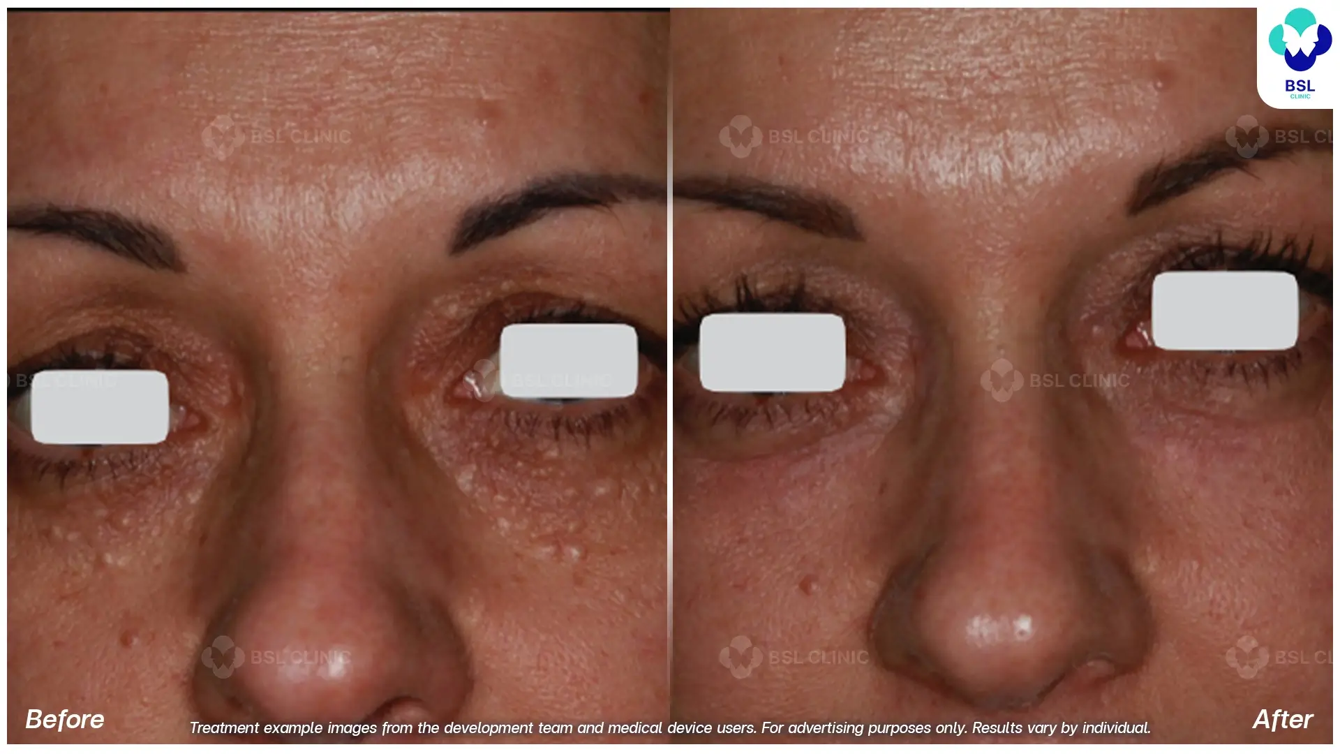 Fractional CO2 Laser Before and After