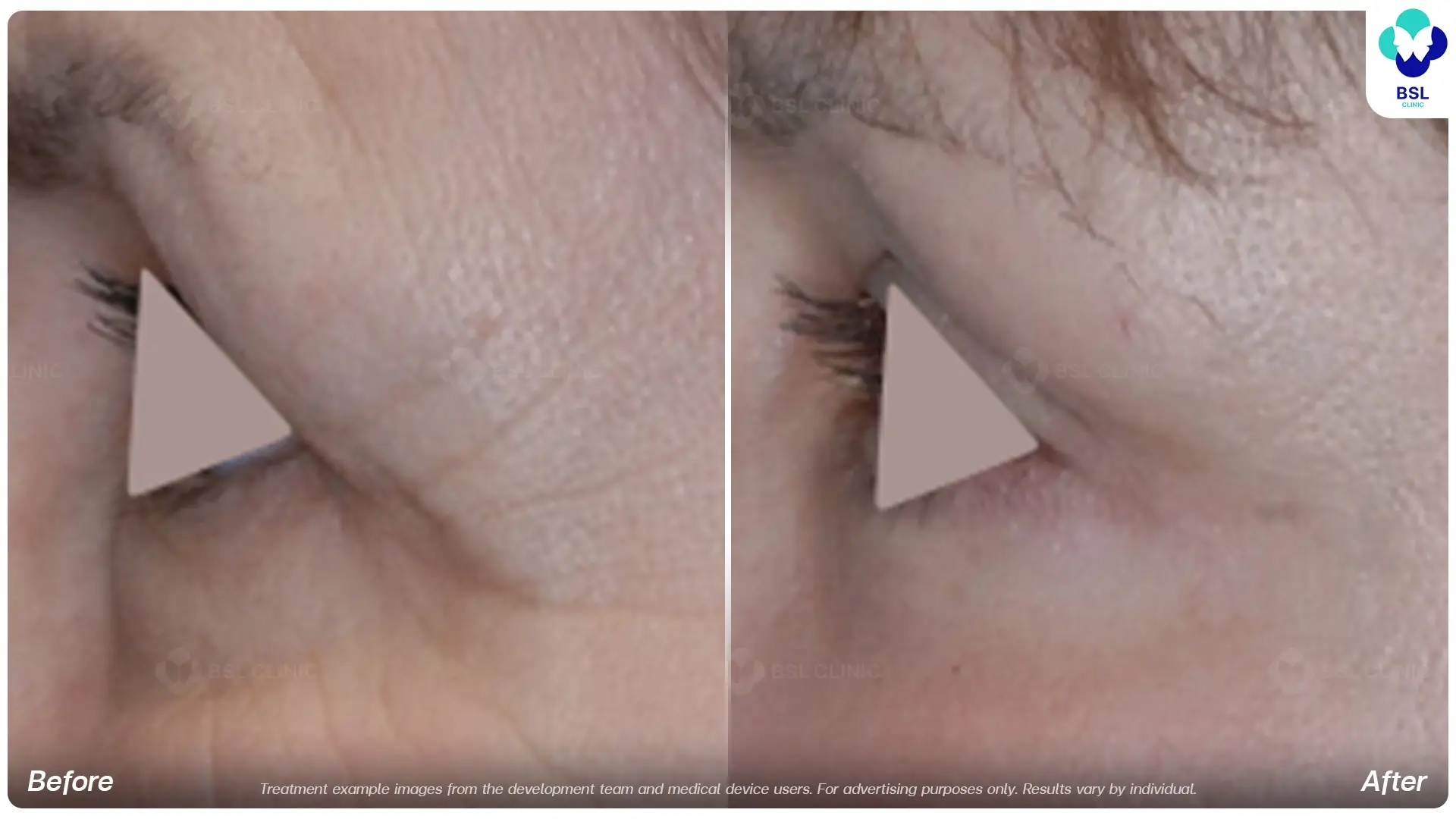 Fine Lines Around the Eyes