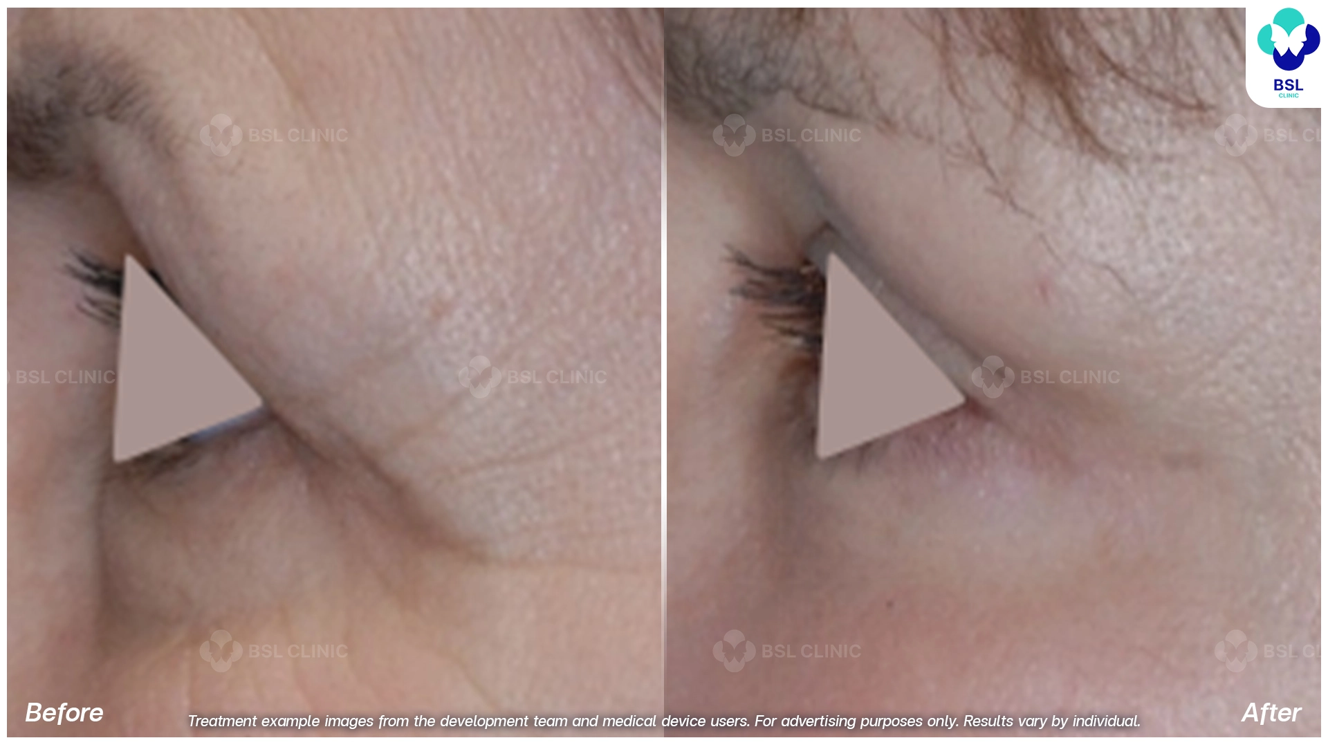 Fine Lines Around the Eyes