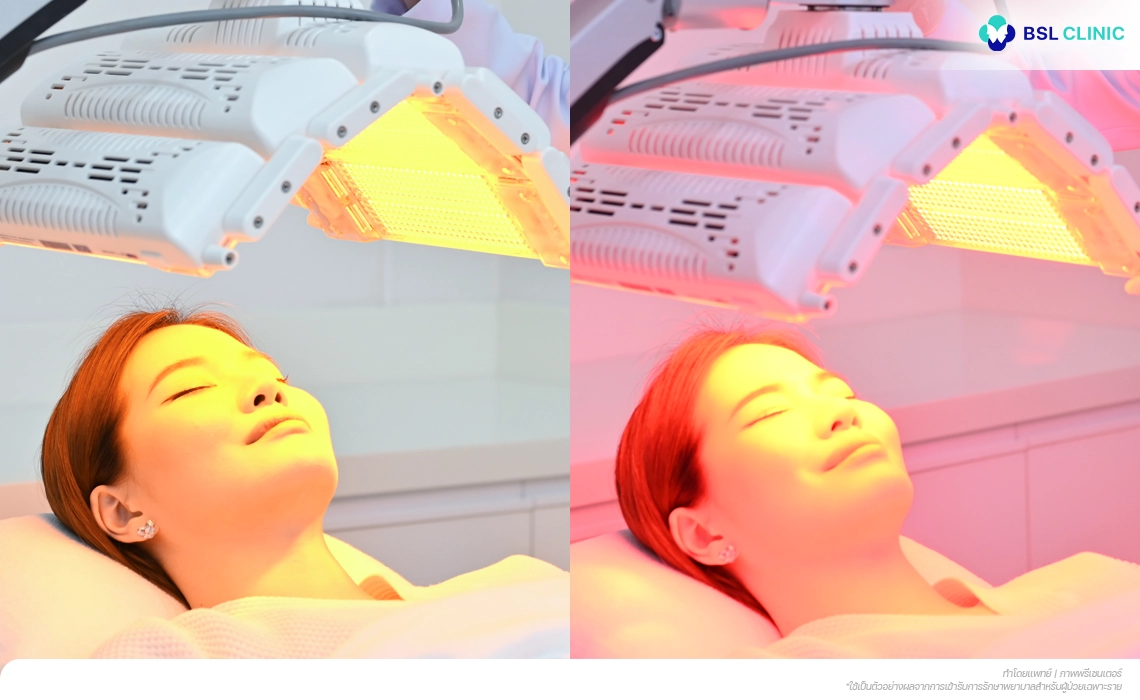Light Therapy Program ฉายแสงรักษาสิว ลดรอยแดง ลดการอักเสบ