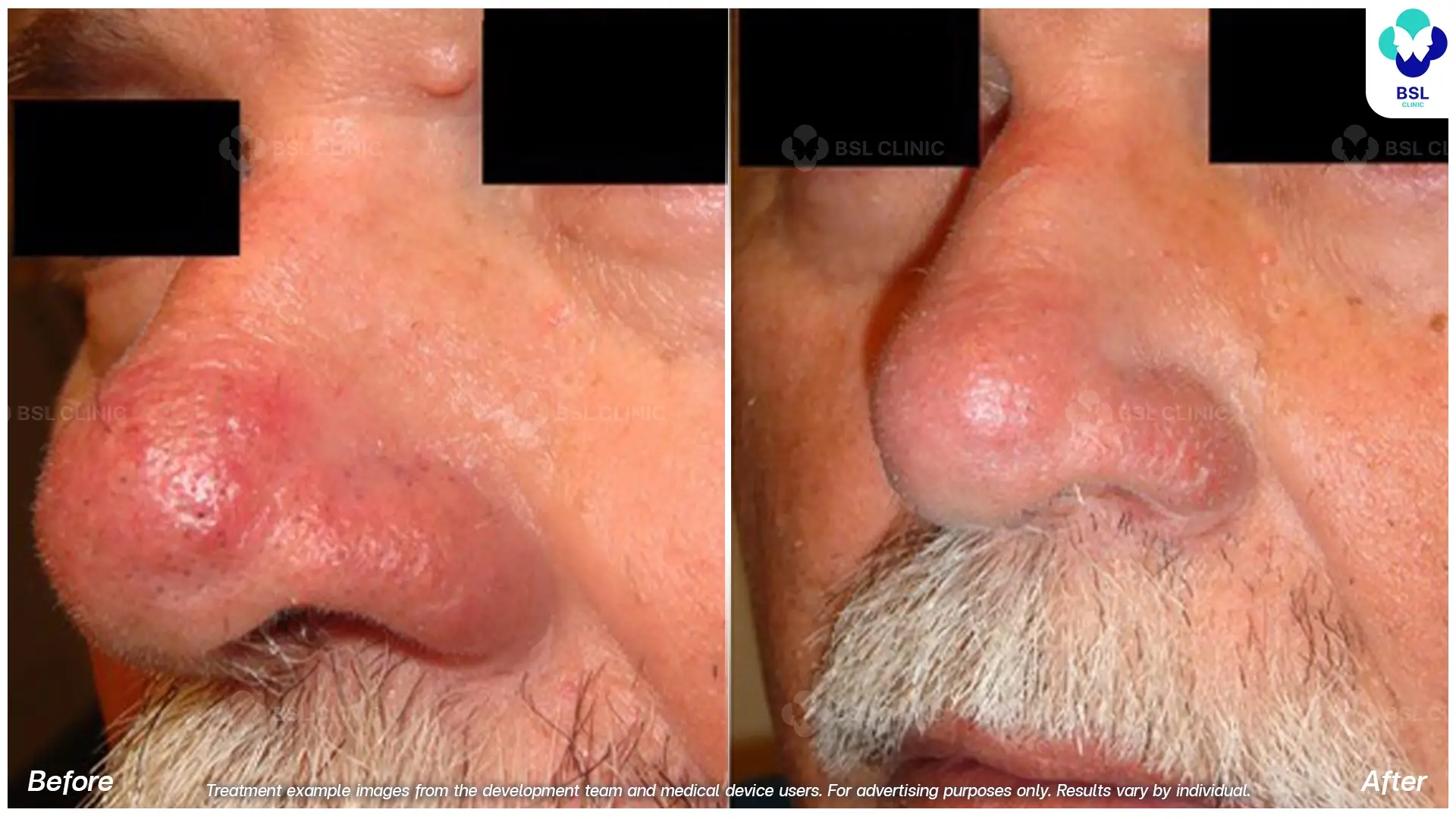 Rhinophyma