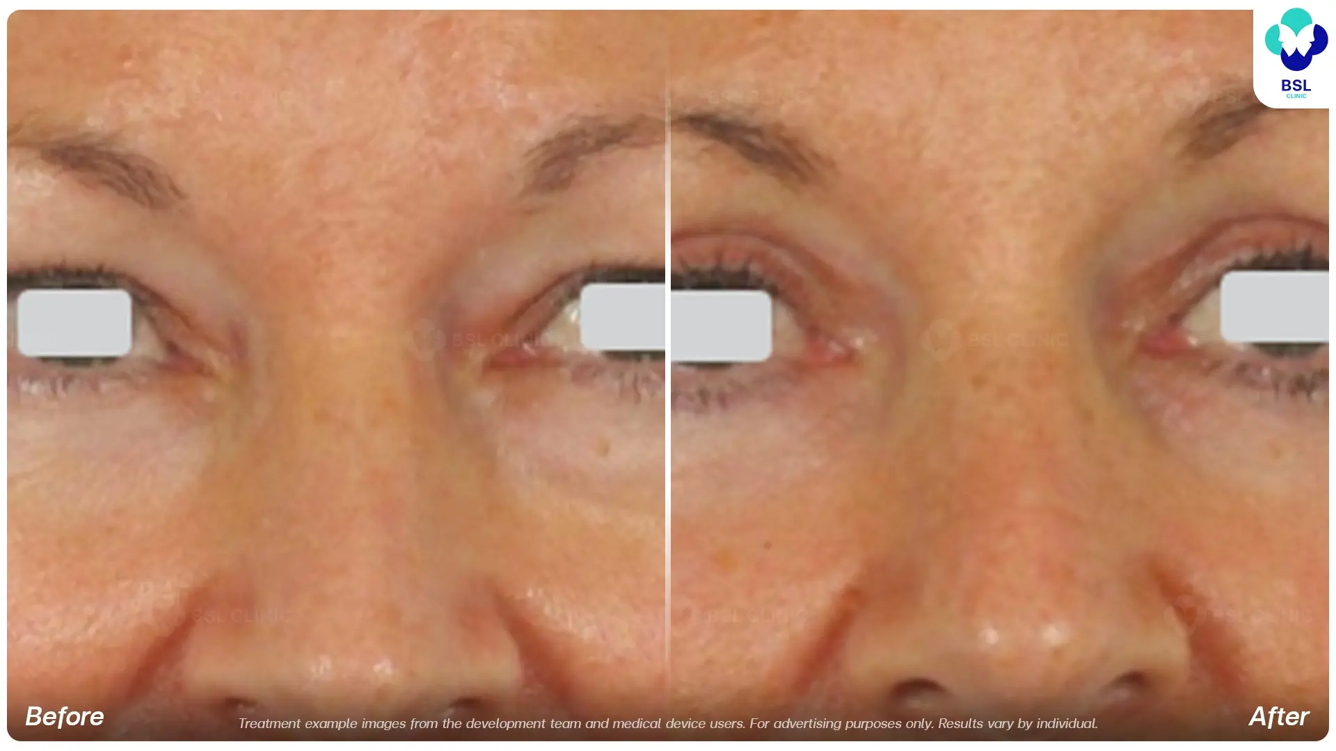 Rhinophyma
