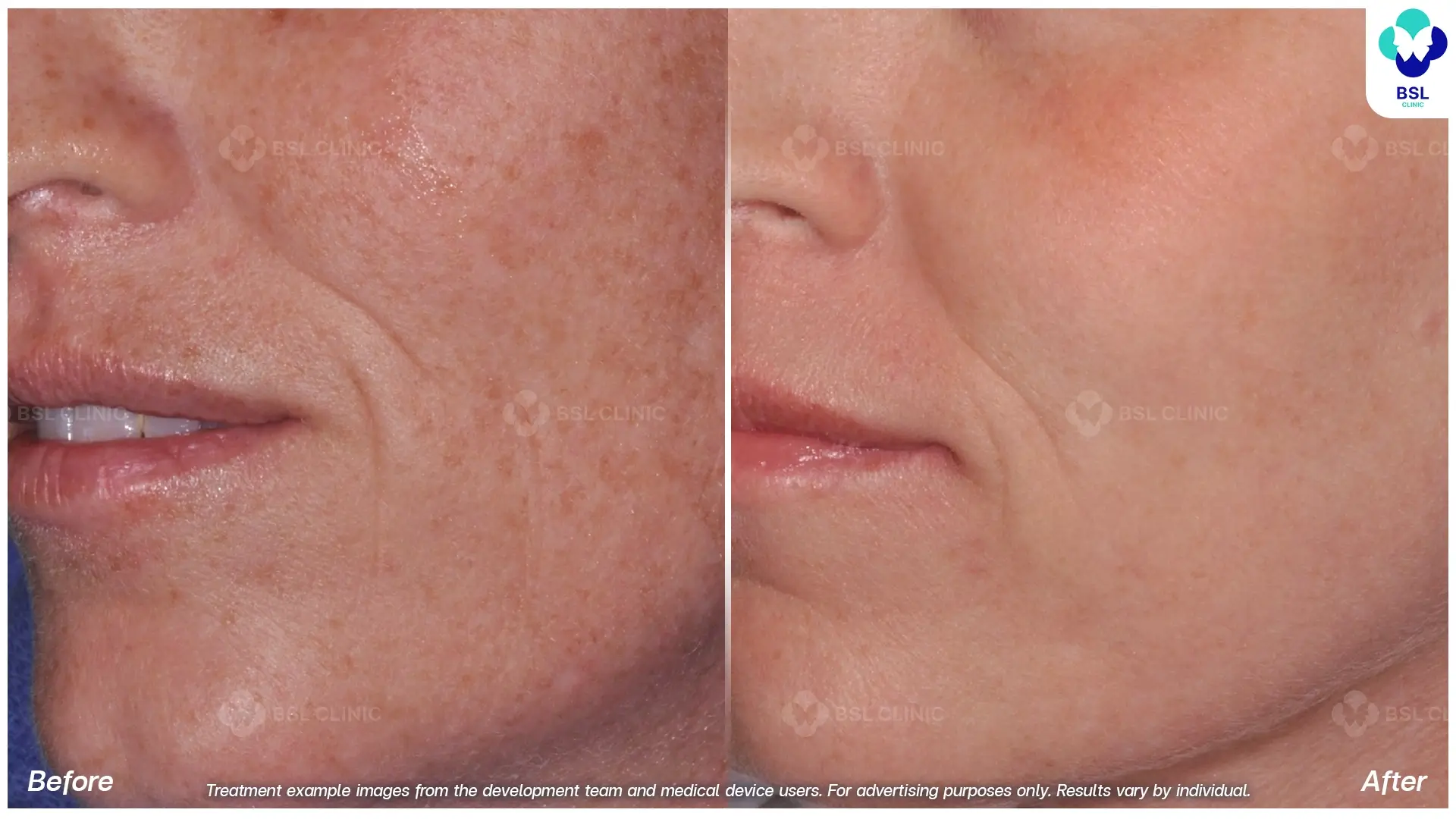 Uneven Skin Tone and Texture