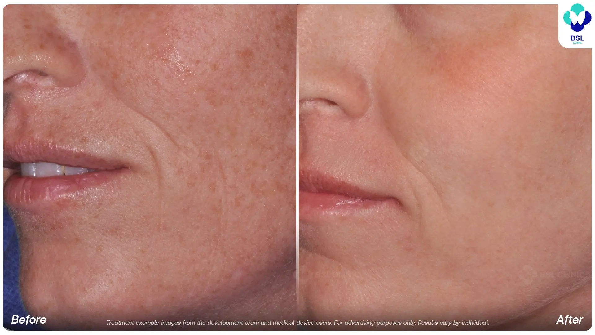 Uneven Skin Tone and Texture