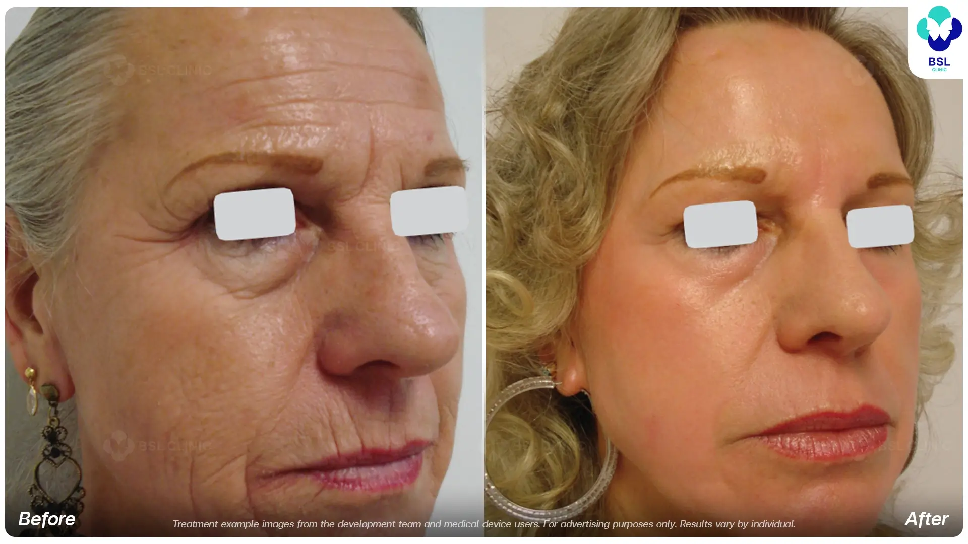 Wrinkles and Fine Lines