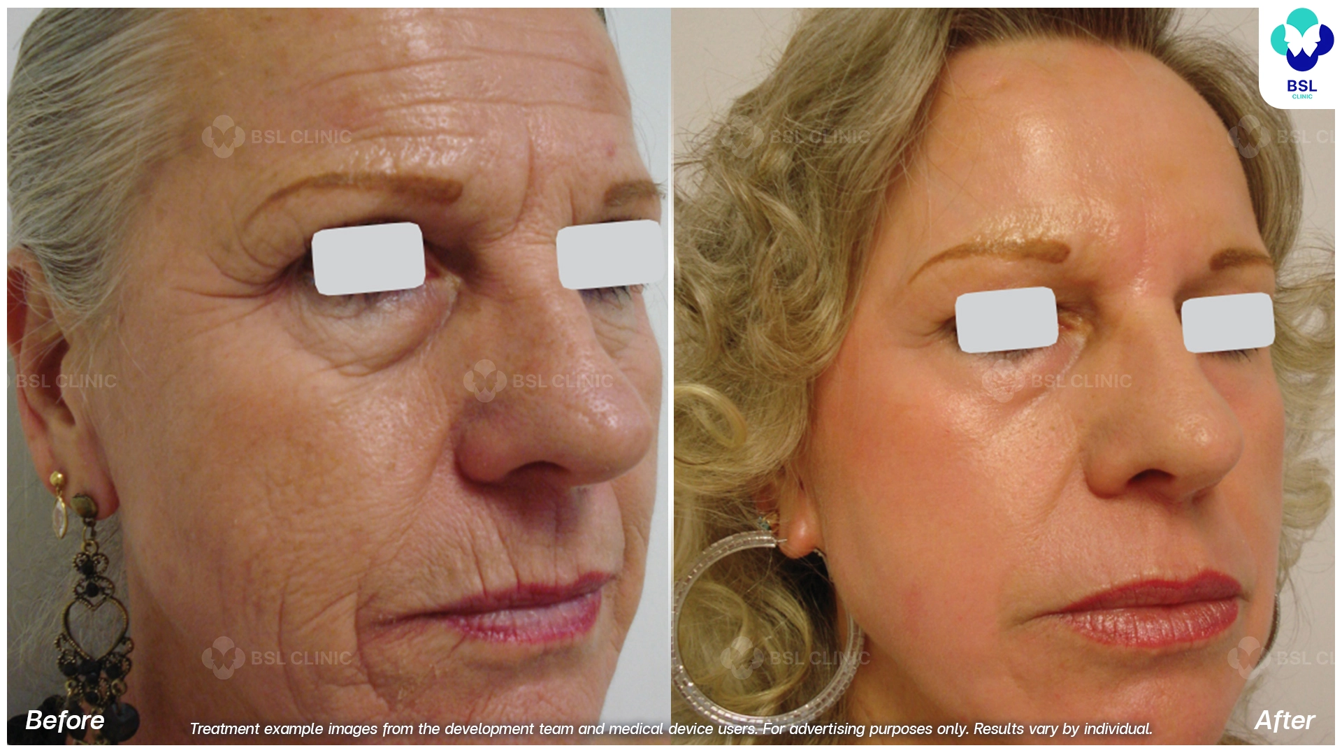Wrinkles and Fine Lines