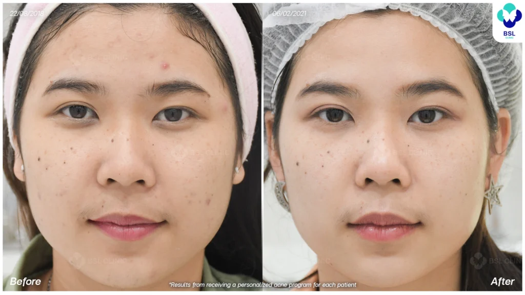 รีวิว ก่อนและหลัง โปรแกรมรักษาสิว รอยสิว หลุมสิว