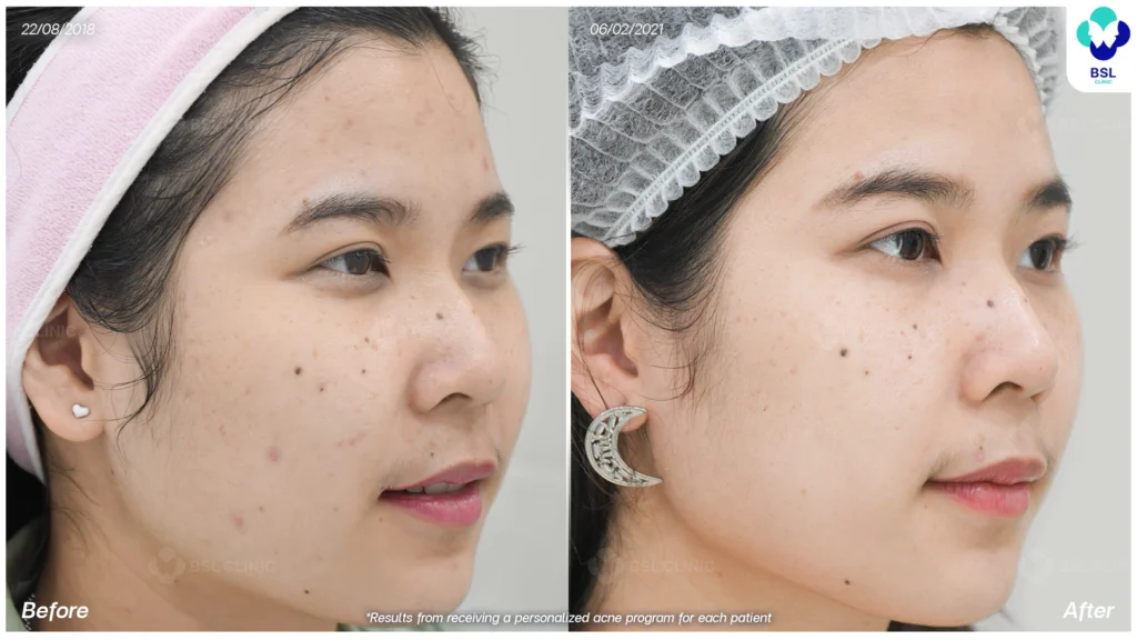 รีวิว ก่อนและหลัง โปรแกรมรักษาสิว รอยสิว หลุมสิว