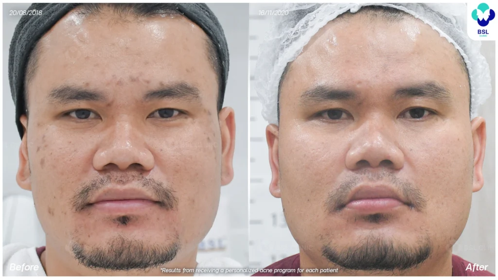 รีวิว ก่อนและหลัง โปรแกรมรักษาสิว รอยสิว หลุมสิว