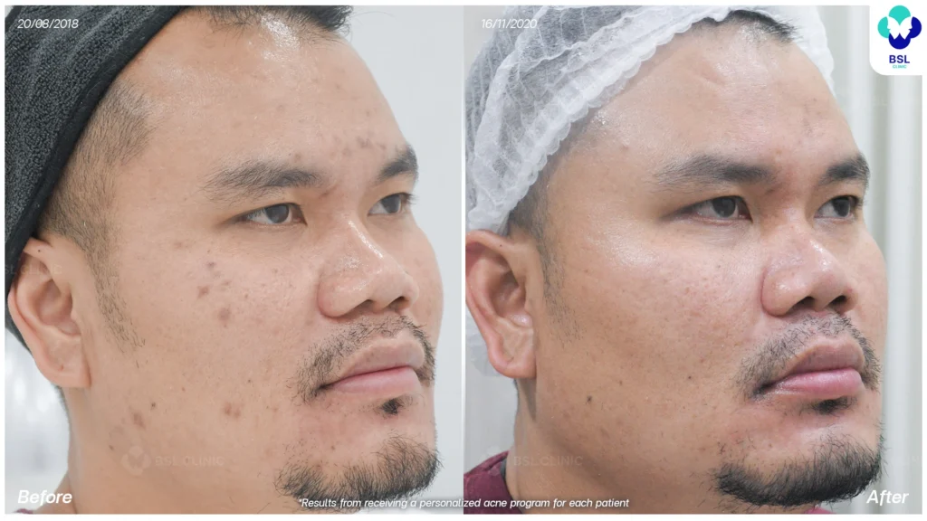 รีวิว ก่อนและหลัง โปรแกรมรักษาสิว รอยสิว หลุมสิว