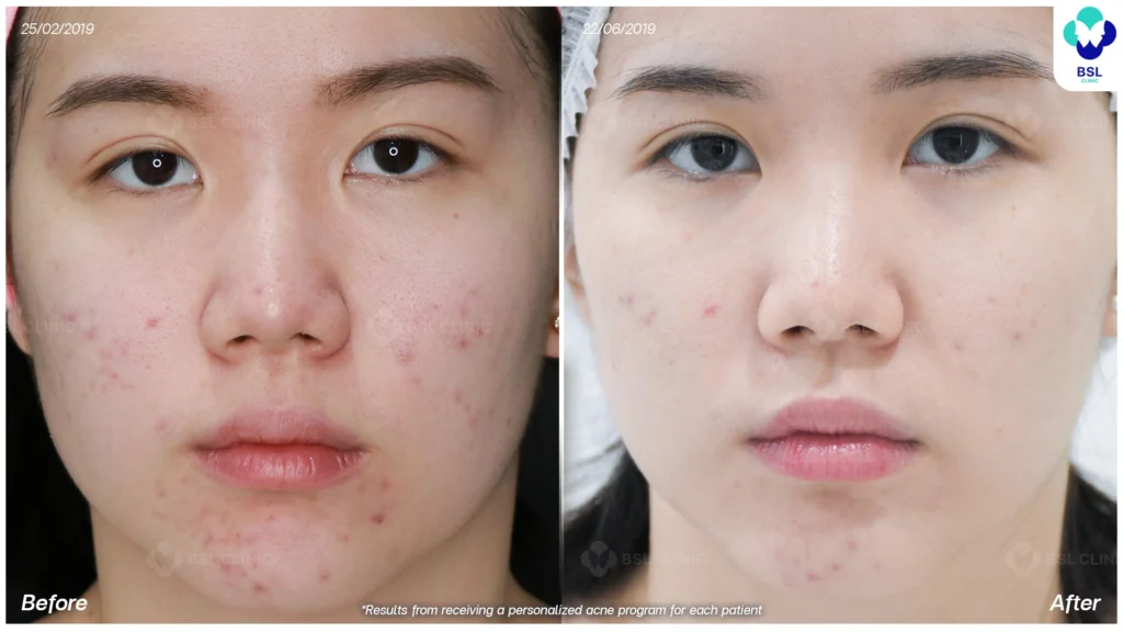 รีวิว ก่อนและหลัง โปรแกรมรักษาสิว รอยสิว หลุมสิว