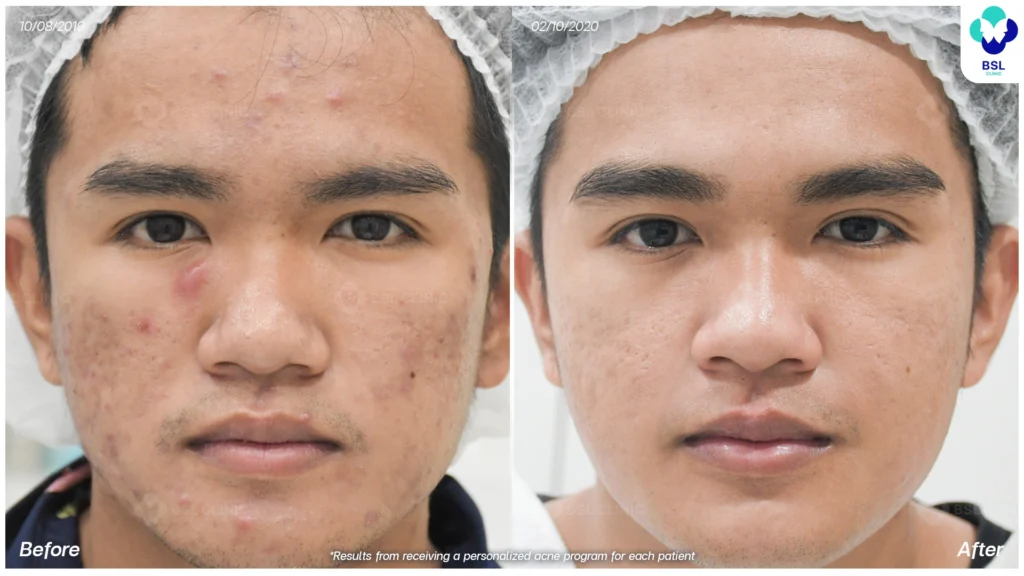 รีวิว ก่อนและหลัง โปรแกรมรักษาสิว รอยสิว หลุมสิว