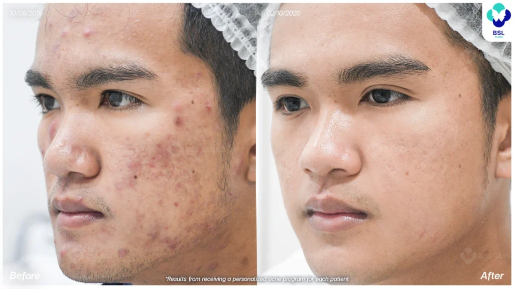 รีวิว ก่อนและหลัง โปรแกรมรักษาสิว รอยสิว หลุมสิว