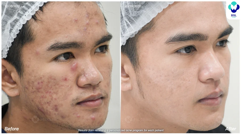 รีวิว ก่อนและหลัง โปรแกรมรักษาสิว รอยสิว หลุมสิว