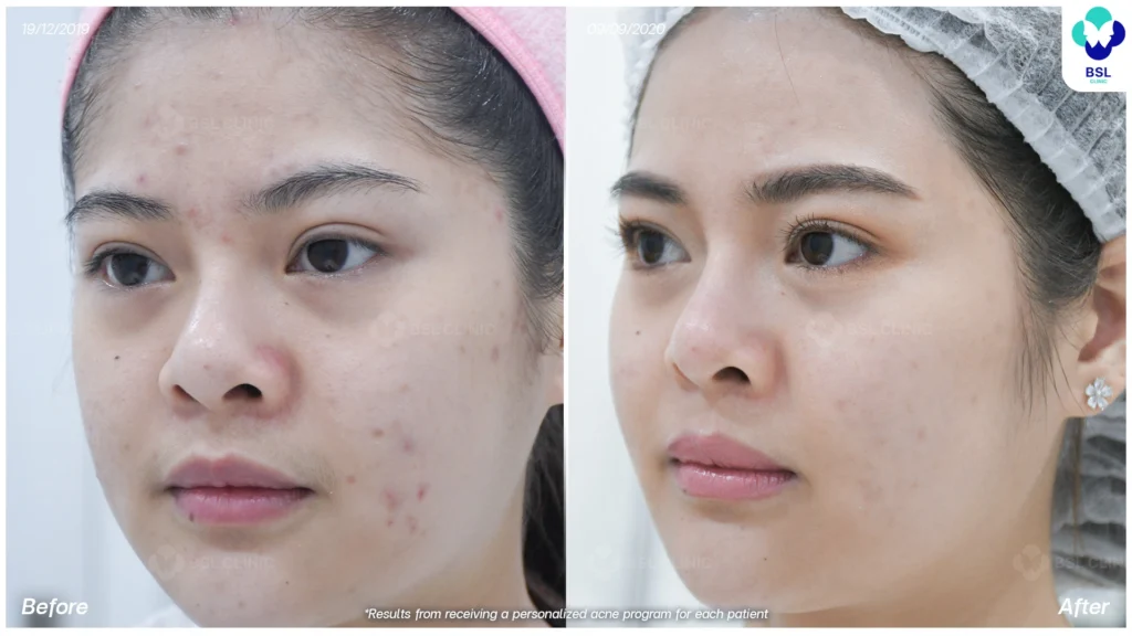 รีวิว ก่อนและหลัง โปรแกรมรักษาสิว รอยสิว หลุมสิว