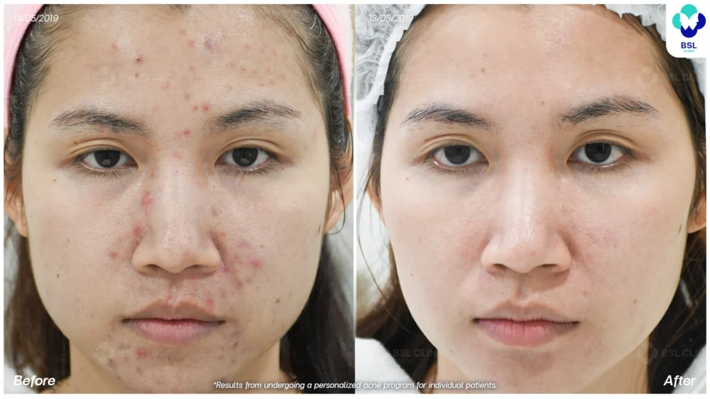 รีวิว ก่อนและหลัง โปรแกรมรักษาสิว รอยสิว หลุมสิว