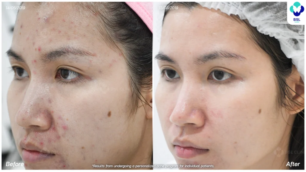 รีวิว ก่อนและหลัง โปรแกรมรักษาสิว รอยสิว หลุมสิว