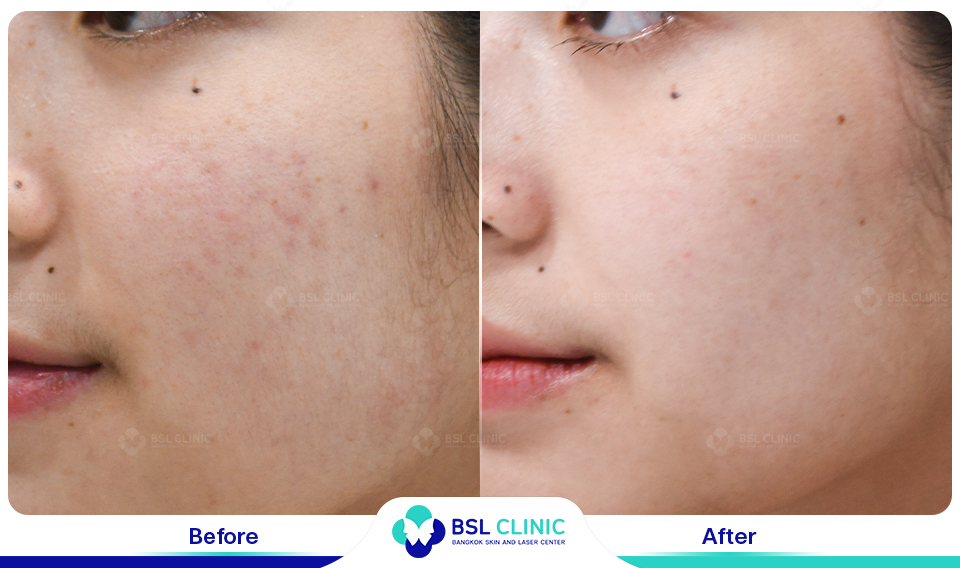 รีวิวเลเซอร์รอยแดงสิว เห็นผลไหม