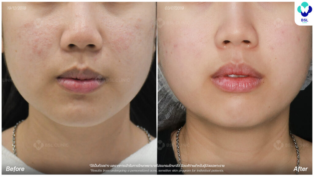 รีวิวเลเซอร์รอยหลุมสิว เห็นผลไหม