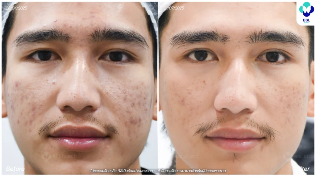 รีวิว ก่อนและหลัง โปรแกรมรักษาสิว รอยสิว หลุมสิว